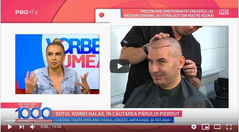Despre operația de implant de păr la Vorbește lumea (PRO TV)